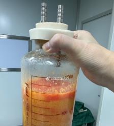 白银水动力吸脂手术要做多久？
